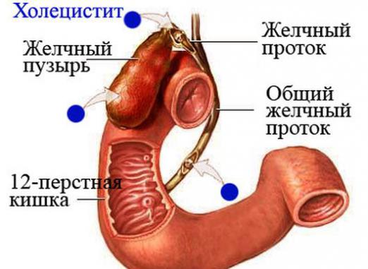 Шта је холециститис?